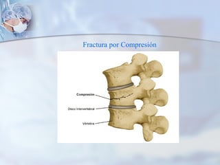 Fractura por Compresión
 