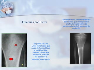 Se puede ver una
Línea radio lúcida que
cruza de forma oblicua
la metáfisis tibial,
rodeada de discreta
esclerosis. Fractura
por estrés de 3
semanas de evolución
Se observa una banda metafisaria
radio densa que corresponde a
una fractura pos estrés de
aproximadamente 5 semanas de
evolución
Fracturas por Estrés
 