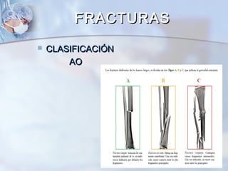  CLASIFICACIÓNCLASIFICACIÓN
AOAO
FRACTURASFRACTURAS
 