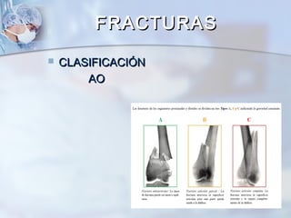 FRACTURASFRACTURAS
 CLASIFICACIÓNCLASIFICACIÓN
AOAO
 