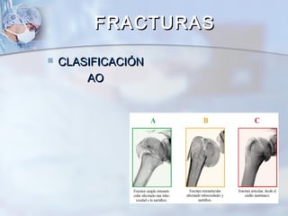 FRACTURASFRACTURAS
 CLASIFICACIÓNCLASIFICACIÓN
AOAO
 