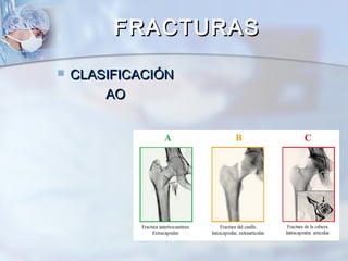 FRACTURASFRACTURAS
 CLASIFICACIÓNCLASIFICACIÓN
AOAO
 