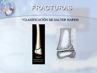 CLASIFICACIÓN DE SALTER HARRISCLASIFICACIÓN DE SALTER HARRIS
FRACTURASFRACTURAS
 