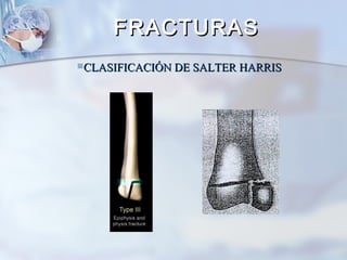 CLASIFICACIÓN DE SALTER HARRISCLASIFICACIÓN DE SALTER HARRIS
FRACTURASFRACTURAS
 