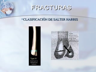 CLASIFICACIÓN DE SALTER HARRISCLASIFICACIÓN DE SALTER HARRIS
FRACTURASFRACTURAS
 