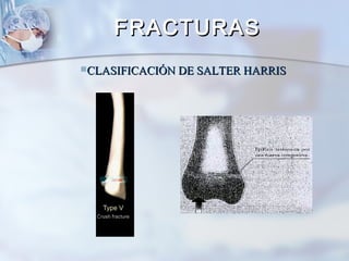 CLASIFICACIÓN DE SALTER HARRISCLASIFICACIÓN DE SALTER HARRIS
FRACTURASFRACTURAS
 