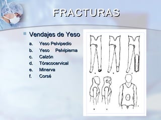  Vendajes de YesoVendajes de Yeso
a.a. Yeso PelvipedioYeso Pelvipedio
b.b. YesoYeso PelvipiernaPelvipierna
c.c. CalzónCalzón
d.d. TóracocervicalTóracocervical
e.e. MinervaMinerva
f.f. CorséCorsé
FRACTURASFRACTURAS
 