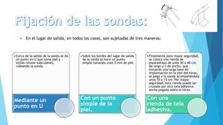  En el lugar de salida, en todos los casos, son sujetadas de tres maneras:
•Cerca de la salida de la sonda se da
un punto en U que toma piel y
tejido celular subcutáneo,
rodeando la sonda.
Mediante un
punto en U
•Sobre los bordes del lugar de salida
de la sonda se hace un punto
simple tomando unos 5 mm de piel.
Con un punto
simple de la
piel.
•Finalmente para mayor seguridad,
se coloca una rienda de
esparadrapo de unos 30 a 40 cm.
De largo y 2 de ancho, que
tomando una larga base de
implantación en la piel del tórax,
se pega a la sonda acompañándola
unos 10 a 15 cm. Par mayor
seguridad, esta rienda puede ser
cruzada por otra tela adhesiva
ancha pegada sobre el tórax.
Con una
rienda de tela
adhesiva.
 