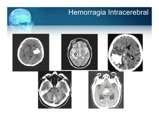 Hemorragia Intracerebral
 