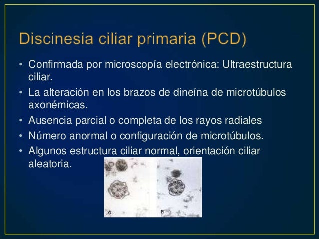Sinusitis Radiology Reference Article Radiopaedia Org Sinusitis Radiology Reference Article Radiopaedia Org