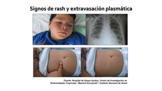 MANEJO CLINICO DE CASOS DE DENGUE CON SIGNOS DE ALARMA Y SIN SIGNOS | PPTX