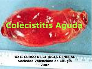 Colecistitis Aguda
XXII CURSO DE CIRUGIA GENERAL
Sociedad Valenciana de Cirugía
2007
 