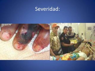 Severidad:
 