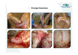 • Cirurgia Cesariana
 
