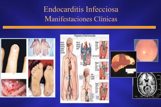 Endocarditis Infecciosa
Manifestaciones Clínicas
 