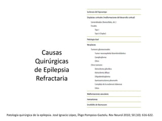 Causas
Quirúrgicas
de Epilepsia
Refractaria
Patología quirúrgica de la epilepsia. José Ignacio López, Íñigo Pomposo-Gaztelu. Rev Neurol 2010; 50 (10): 616-622.
 