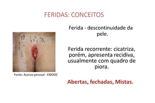 FERIDAS: CONCEITOS
Ferida - descontinuidade da
pele.
Ferida recorrente: cicatriza,
porém, apresenta recidiva,
usualmente com quadro de
piora.
Abertas, fechadas, Mistas.
Fonte: Acervo pessoal - EMDOC
 