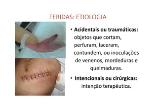 FERIDAS: ETIOLOGIA
• Acidentais ou traumáticas:
objetos que cortam,
perfuram, laceram,
contundem, ou inoculações
de venenos, mordeduras e
queimaduras.
• Intencionais ou cirúrgicas:
intenção terapêutica.
 