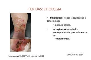 FERIDAS: ETIOLOGIA
• Patológicas: lesões secundárias à
determinada
• doença básica.
• Iatrogênicas: resultados
inadequados de procedimentos
ou
• tratamentos.
GEOVANINI, 2014
Fonte: Acervo UNESC/PMC – Acervo EMDOC
 