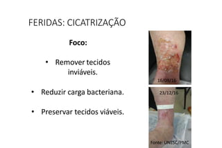 Foco:
• Remover tecidos
inviáveis.
• Reduzir carga bacteriana.
• Preservar tecidos viáveis.
FERIDAS: CICATRIZAÇÃO
16/09/16
23/12/16
Fonte: UNESC/PMC
 