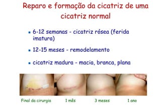 Reparo e formação da cicatriz de uma
cicatriz normal
 6-12 semanas - cicatriz rósea (ferida
imatura)
 12-15 meses - remodelamento
 cicatriz madura - macia, branca, plana
Final da cirurgia 1 mês 3 meses 1 ano
 