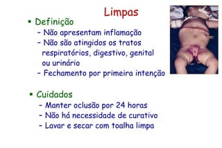 Limpas
 Definição
– Não apresentam inflamação
– Não são atingidos os tratos
respiratórios, digestivo, genital
ou urinário
– Fechamento por primeira intenção
 Cuidados
– Manter oclusão por 24 horas
– Não há necessidade de curativo
– Lavar e secar com toalha limpa
 