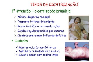 TIPOS DE CICATRIZAÇÃO
 Mínimo de perda tecidual
 Resposta inflamatória rápida
 Reduz incidência de complicações
 Bordos regulares unidos por suturas
 Cicatriz com menor índice de defeitos
1ª intenção – cicatrização primária
 Cuidados
 Manter oclusão por 24 horas
 Não há necessidade de curativo
 Lavar e secar com toalha limpa
 