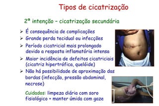 Tipos de cicatrização
 É consequência de complicações
 Grande perda tecidual ou infecções
 Período cicatricial mais prolongado
devido a resposta inflamatória intensa
 Maior incidência de defeitos cicatriciais
(cicatriz hipertrófica, quelóide)
 Não há possibilidade de aproximação das
bordas (infecção, pressão abdominal,
necrose)
2ª intenção – cicatrização secundária
Cuidados: limpeza diária com soro
fisiológico + manter úmida com gaze
 