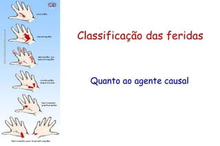 Classificação das feridas
Quanto ao agente causal
 