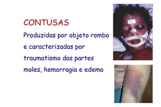CONTUSAS
Produzidas por objeto rombo
e caracterizadas por
traumatismo das partes
moles, hemorragia e edema
 