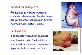 Incisas ou cirúrgicas
Produzidas por um instrumento
cortante. Geralmente feridas limpas
são geralmente fechadas por suturas
Agentes: faca, bisturi, lâmina
Perfurantes
São caracterizadas por pequenas
aberturas na pele. Predomínio da
profundidade sobre o comprimento
Agentes: bala ou ponta de faca
 