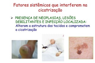 Fatores sistêmicos que interferem na
cicatrização
 PRESENÇA DE NEOPLASIAS, LESÕES
DEBILITANTES E INFECÇÃO LOCALIZADA:
Alteram a estrutura dos tecidos e comprometem
a cicatrização
 