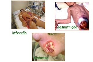 infecção
desnutrição
diabetes
 