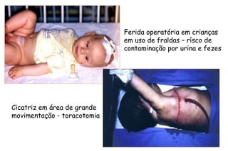 Ferida operatória em crianças
em uso de fraldas – rísco de
contaminação por urina e fezes
Cicatriz em área de grande
movimentação - toracotomia
 