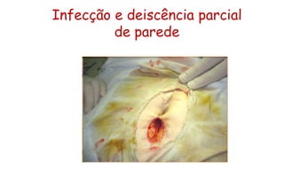 Infecção e deiscência parcial
de parede
 