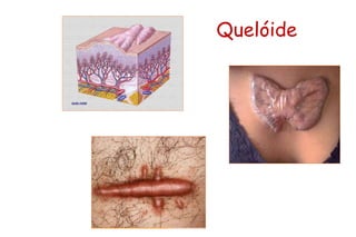 Quelóide
 