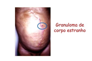 Granuloma de
corpo estranho
 