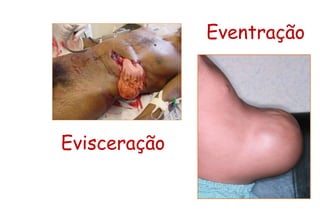 Eventração
Evisceração
 
