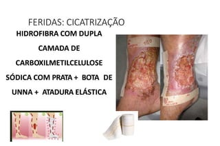 HIDROFIBRA COM DUPLA
CAMADA DE
CARBOXILMETILCELULOSE
SÓDICA COM PRATA + BOTA DE
UNNA + ATADURA ELÁSTICA
FERIDAS: CICATRIZAÇÃO
 