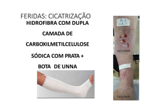 FERIDAS: CICATRIZAÇÃO
HIDROFIBRA COM DUPLA
CAMADA DE
CARBOXILMETILCELULOSE
16/11/2016
SÓDICA COM PRATA +
BOTA DE UNNA
13/12/2016
 