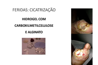 HIDROGEL COM
CARBOXILMETILCELULOSE
E ALGINATO
FERIDAS: CICATRIZAÇÃO
 