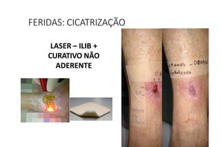 LASER – ILIB +
CURATIVO NÃO
ADERENTE
FERIDAS: CICATRIZAÇÃO
 