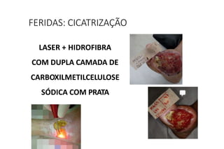 LASER + HIDROFIBRA
COM DUPLA CAMADA DE
CARBOXILMETILCELULOSE
SÓDICA COM PRATA
FERIDAS: CICATRIZAÇÃO
 