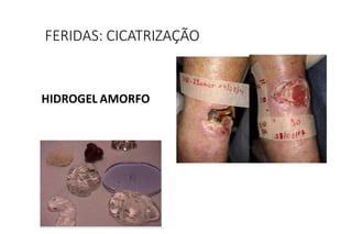 HIDROGEL AMORFO
FERIDAS: CICATRIZAÇÃO
 