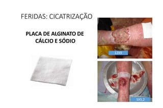 PLACA DE ALGINATO DE
CÁLCIO E SÓDIO
FERIDAS: CICATRIZAÇÃO
12X9
5X5,2
 