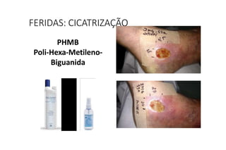 PHMB
Poli-Hexa-Metileno-
Biguanida
FERIDAS: CICATRIZAÇÃO
 