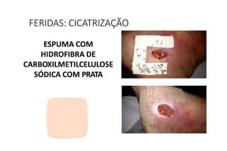 ESPUMA COM
HIDROFIBRA DE
CARBOXILMETILCELULOSE
SÓDICA COM PRATA
FERIDAS: CICATRIZAÇÃO
 
