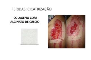 COLAGENO COM
ALGINATO DE CÁLCIO
FERIDAS: CICATRIZAÇÃO
 