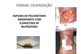 ESPUMA DE POLIURETANO
ABSORVENTE COM
0,5MG/CM2 DE
IBUPROFENO
FERIDAS: CICATRIZAÇÃO
 