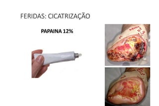 PAPAINA 12%
FERIDAS: CICATRIZAÇÃO
 